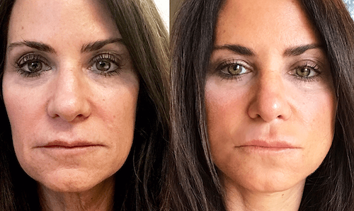 plasma facial skin revitalization before after mississauga oakville